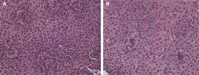 Eosinophilic esophagitis improved by the discontinuation of sublingual immunotherapy for aeroallergens: a case report